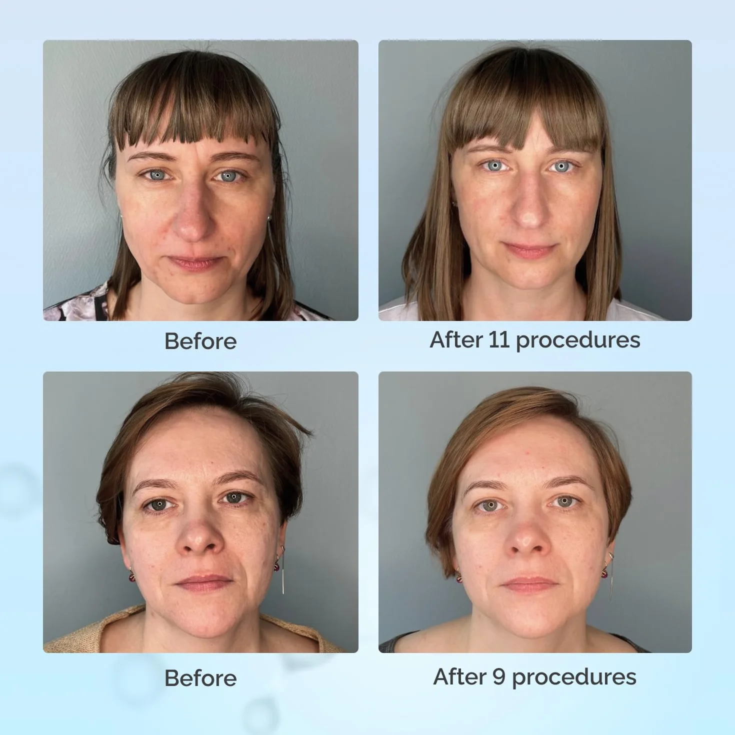GESS FaceActive Professional BMS Biomechaniczny masażer do twarzy – przeciwstarzeniowy, ujędrniający skórę i redukujący zmarszczki, głęboki masażer do twarzy z bezpłatnym samouczkiem wideo od eksperta